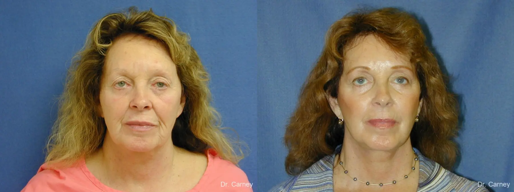 Virginia Beach Facelift 1127 - Before and After 3