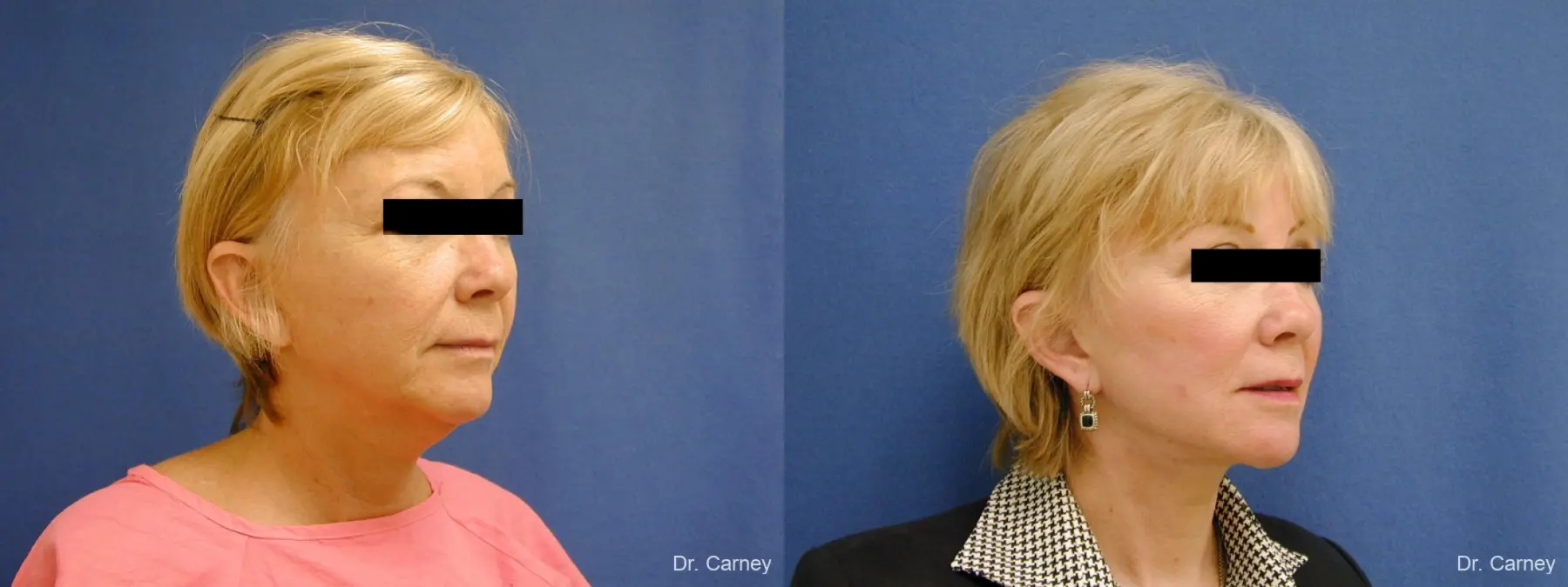 Virginia Beach Facelift 1262 - Before and After 2