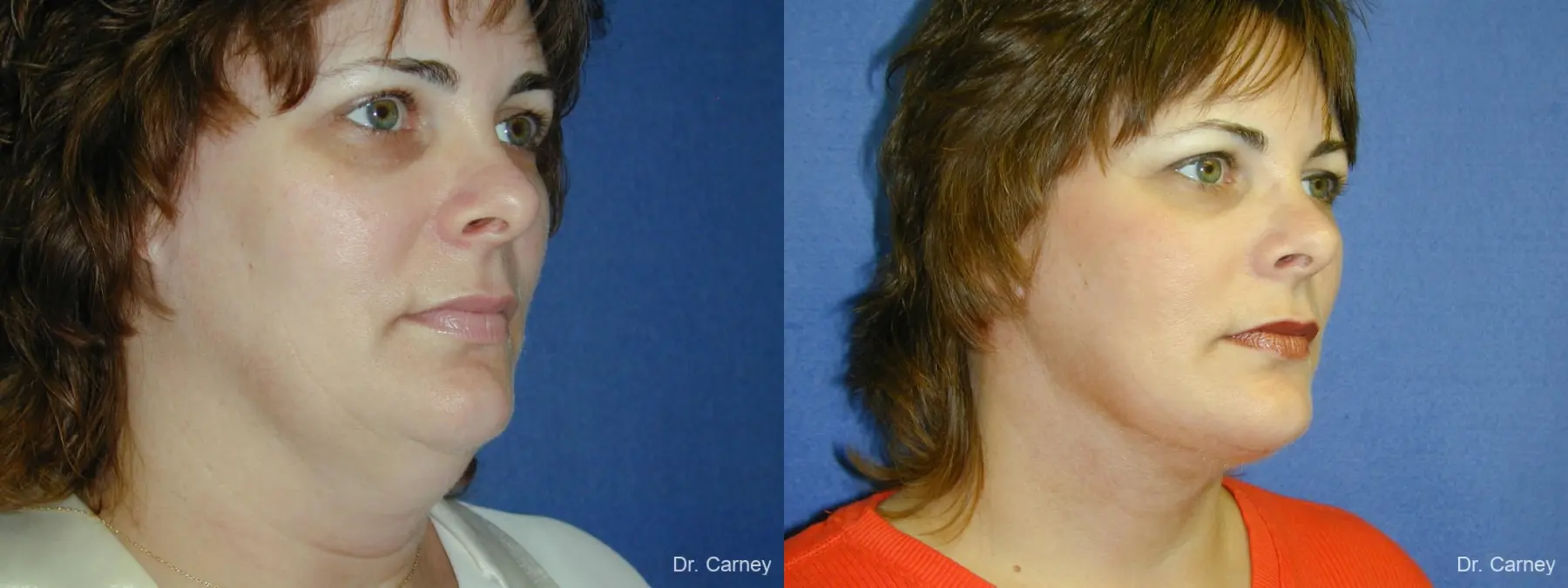 Virginia Beach Facelift 1136 - Before and After 1