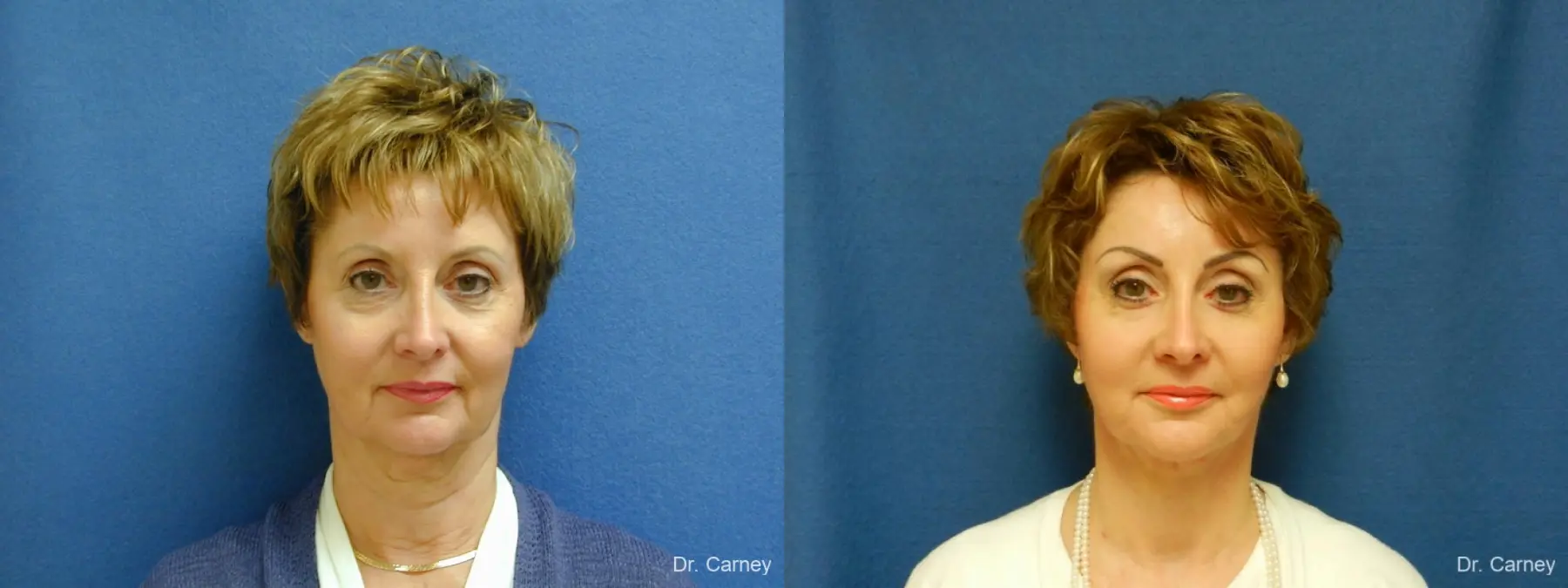 Virginia Beach Facelift 1132 - Before and After