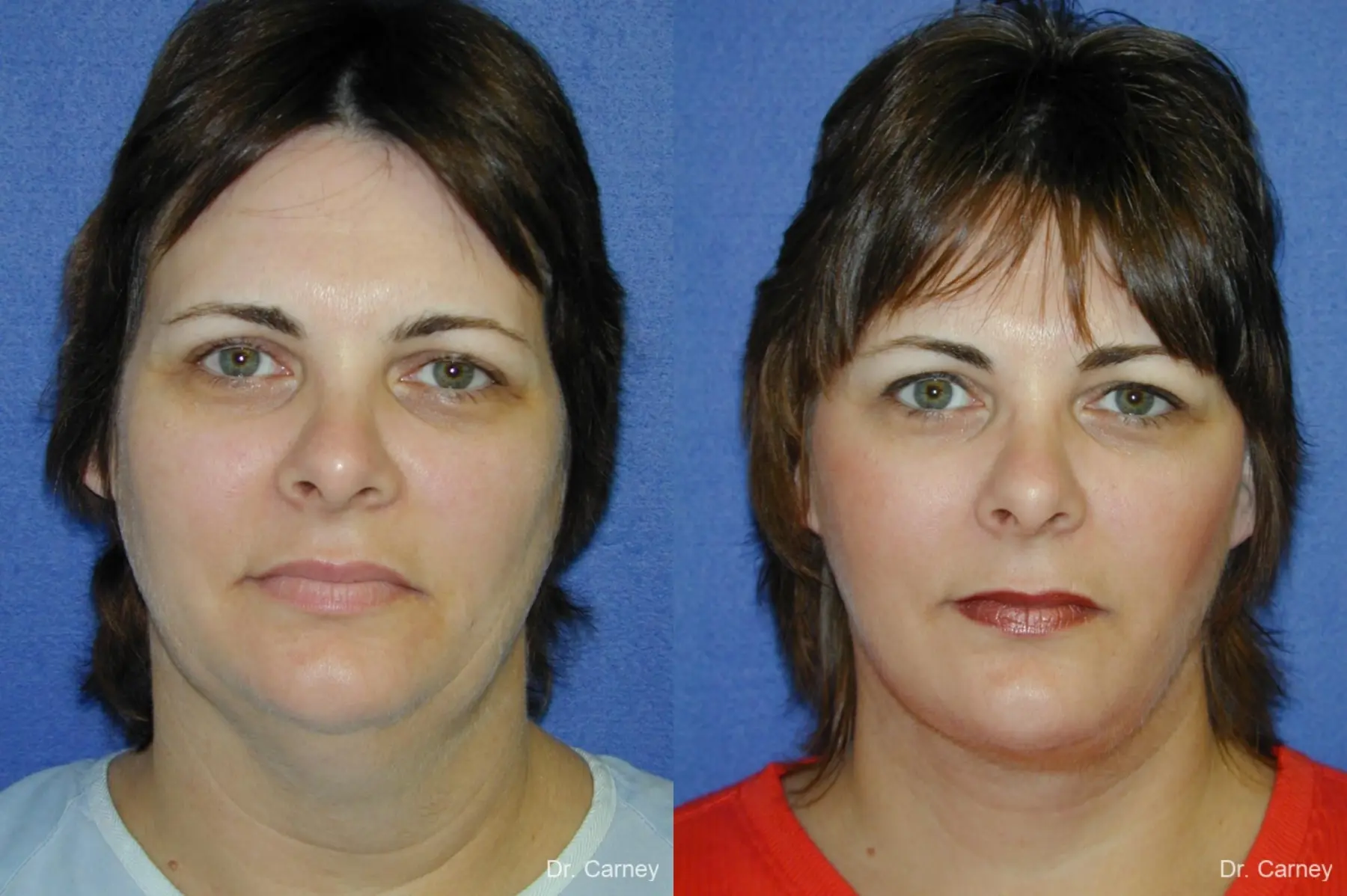 Virginia Beach Facelift 1136 - Before and After 3