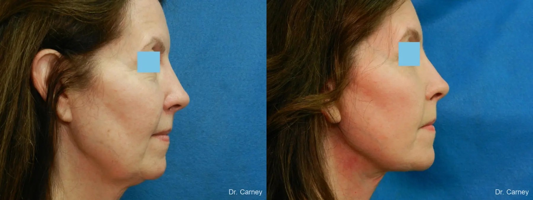 Facelift: Patient 11 - Before and After 3