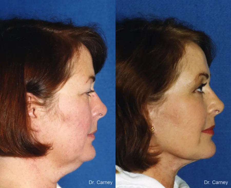 Virginia Beach Facelift 1137 - Before and After 3