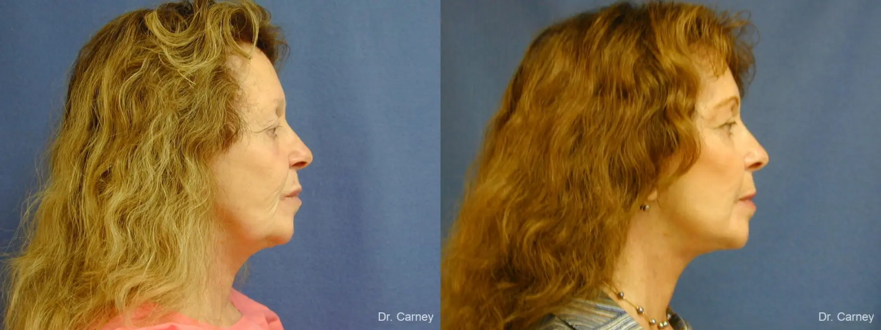 Virginia Beach Facelift 1127 - Before and After 2