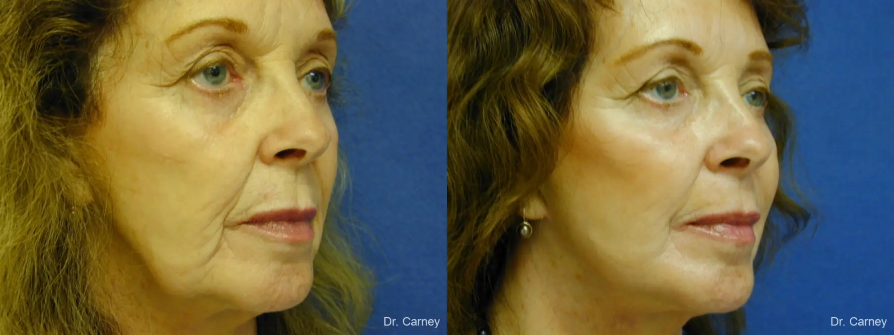 Virginia Beach Facelift 1127 - Before and After