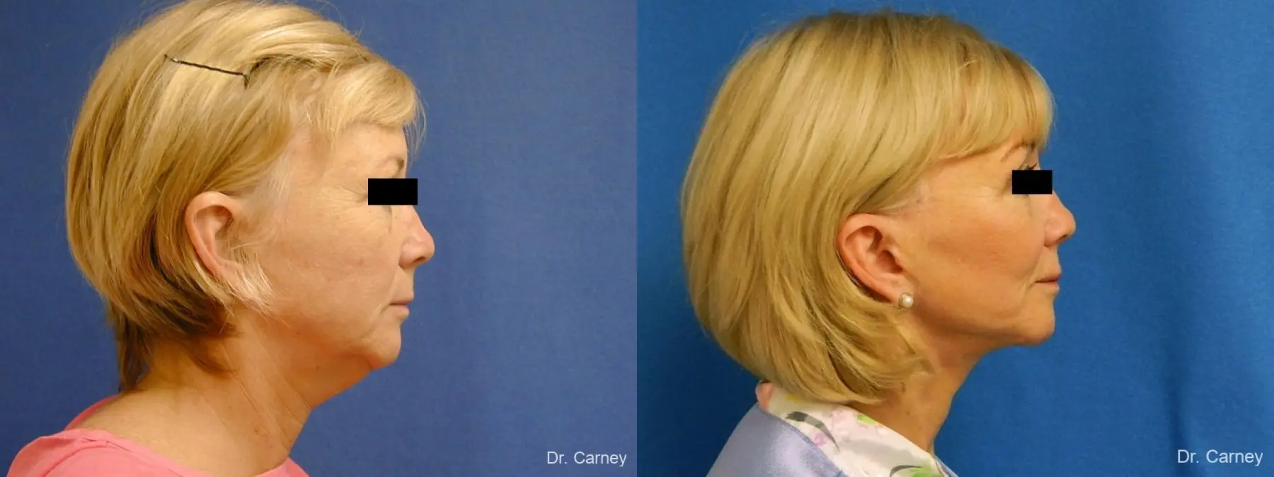 Virginia Beach Facelift 1262 - Before and After 4