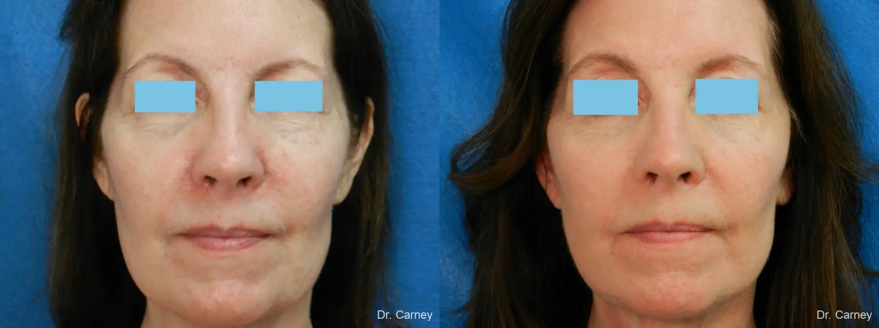 Facelift: Patient 11 - Before and After  