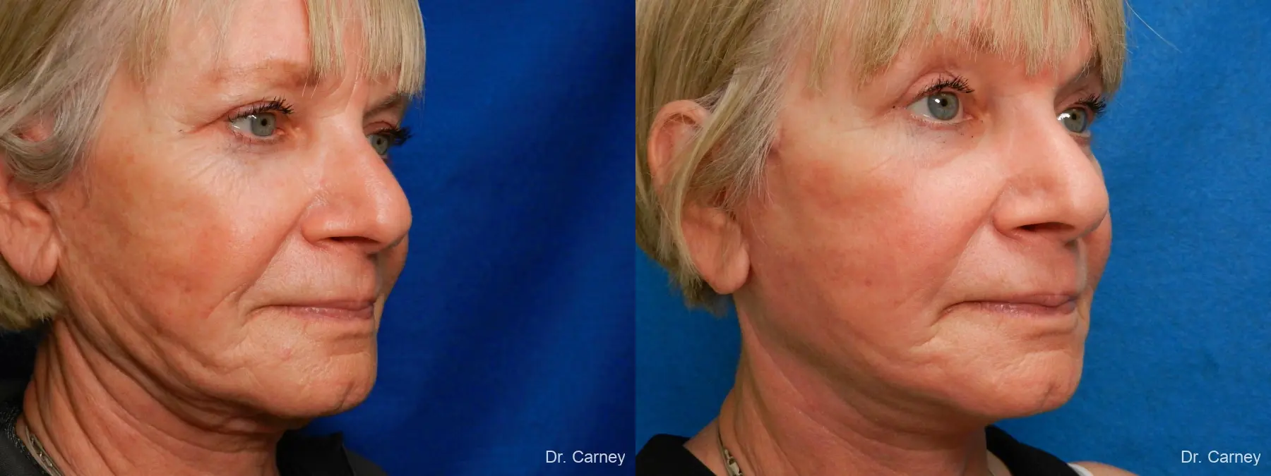 Facelift: Patient 12 - Before and After 2