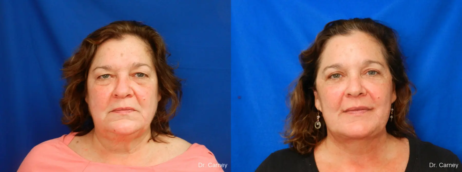 Facelift: Patient 10 - Before and After  