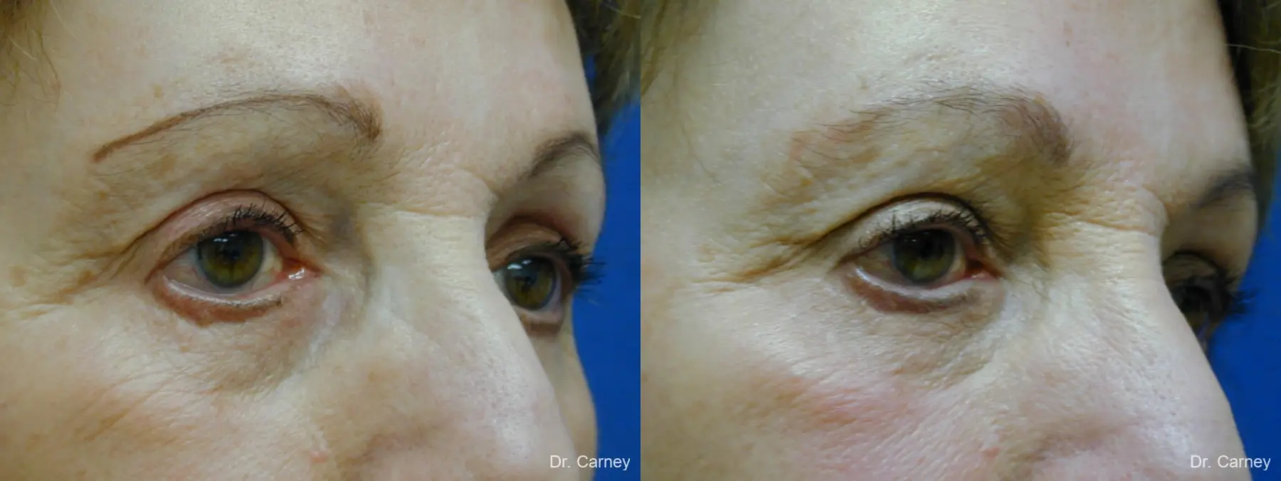 Virginia Beach Facelift 1133 - Before and After 3