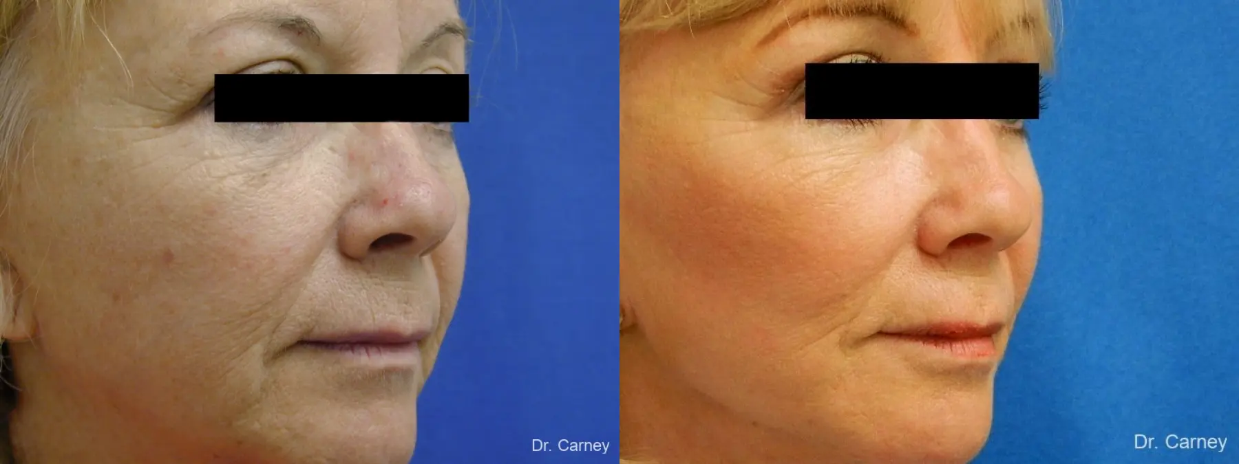 Virginia Beach Facelift 1262 - Before and After 3