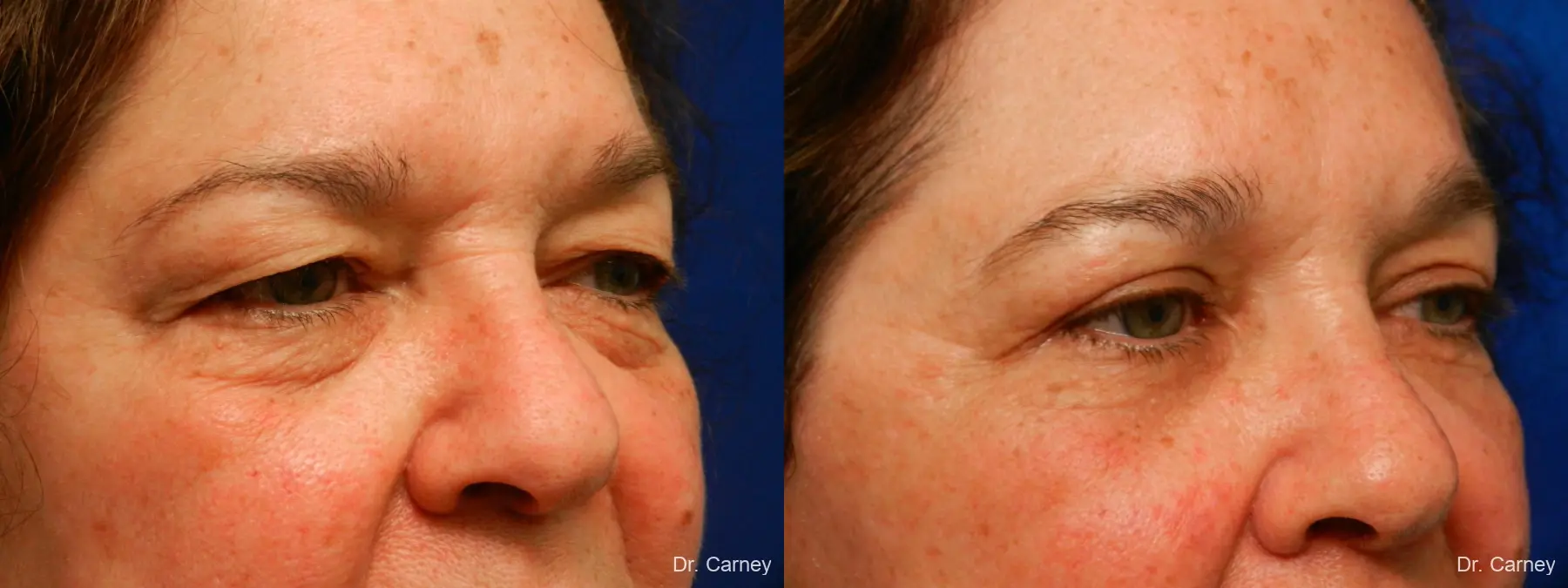 Facelift: Patient 10 - Before and After 5