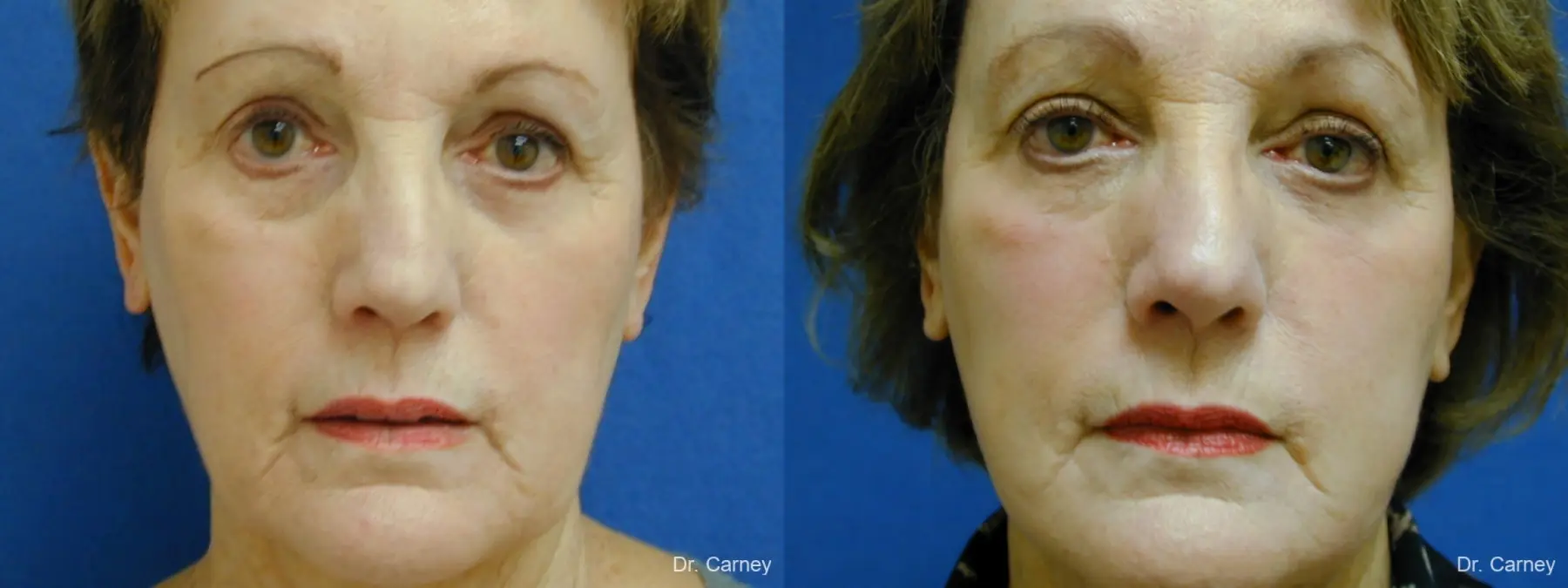Virginia Beach Facelift 1133 - Before and After 2
