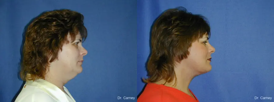 Virginia Beach Facelift 1136 - Before and After 2