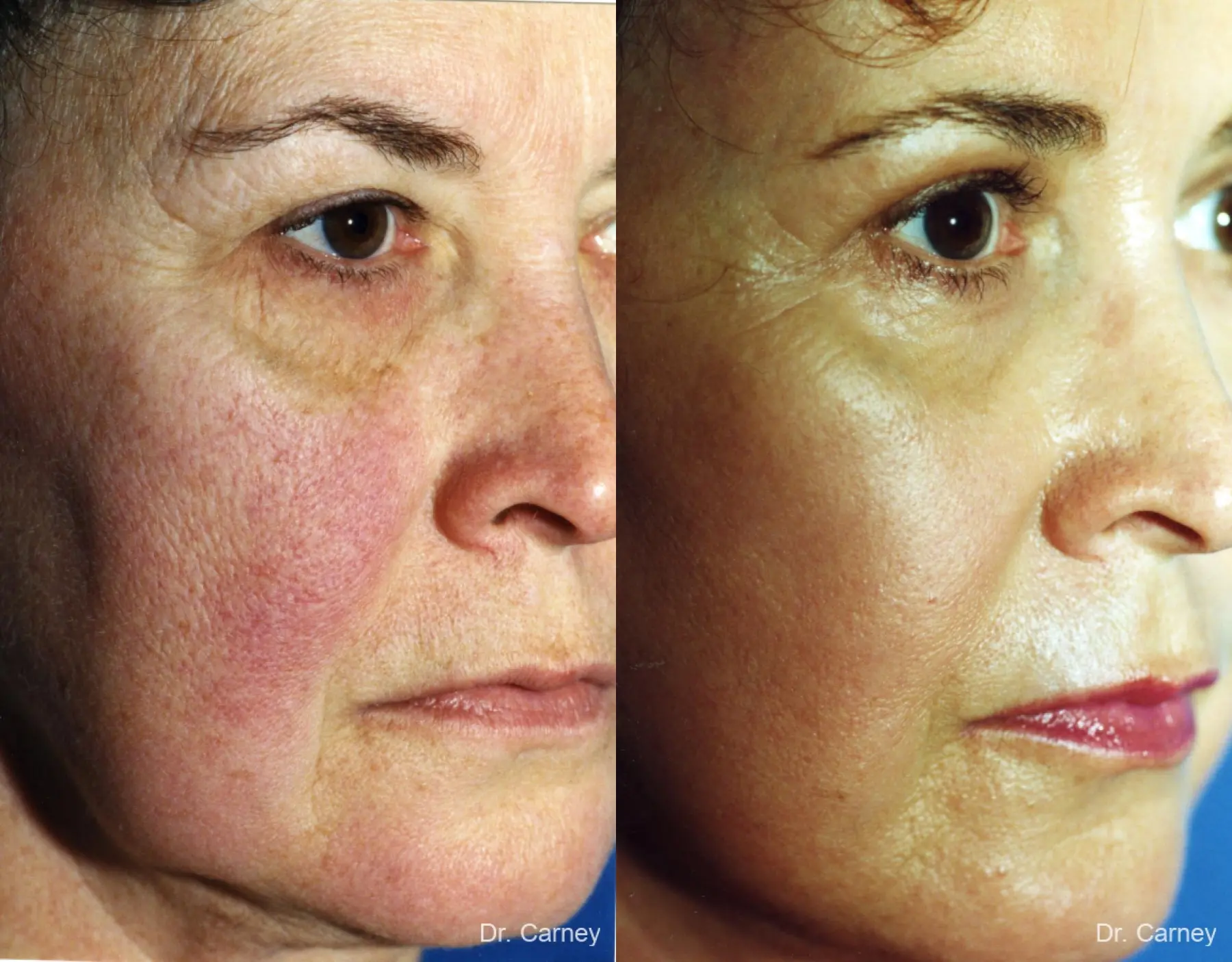 Virginia Beach Facelift 1134 - Before and After 3