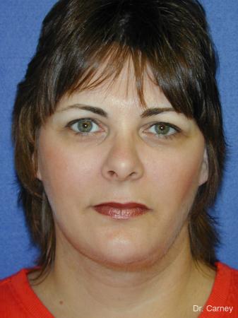 Virginia Beach Neck Lift 1269 - After Image 3