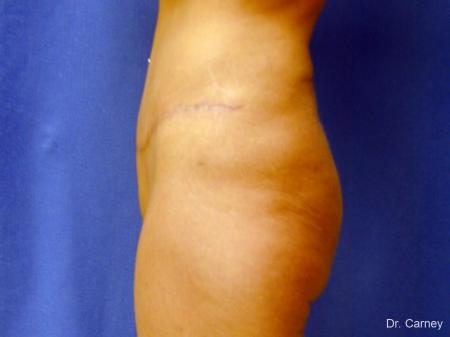 Tummy Tuck: Patient 1 - After Image 4