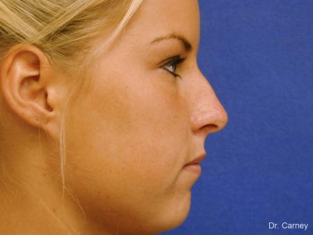 Virginia Beach Rhinoplasty 1218 - Before Image 1