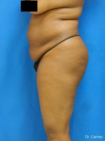 Brazilian Butt Lift: Patient 4 - Before Image 1