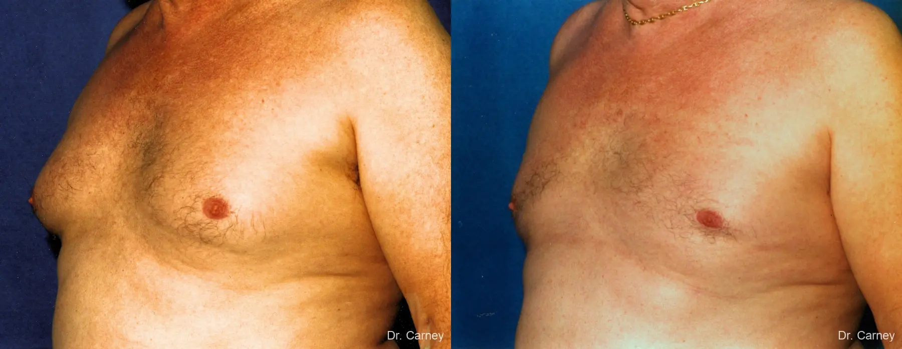 Virginia Beach Gynecomastia 1227 - Before and After 1