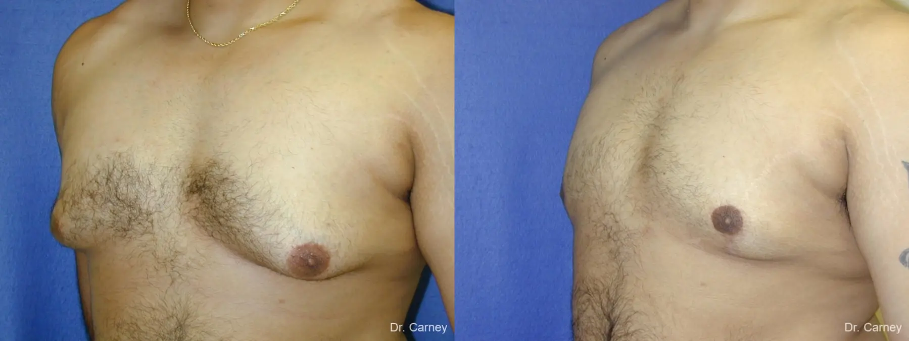 Virginia Beach Gynecomastia 1255 - Before and After 5