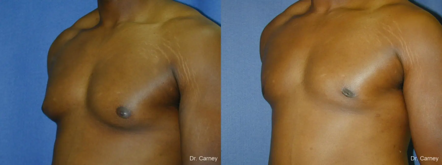 Virginia Beach Gynecomastia 1226 - Before and After 3