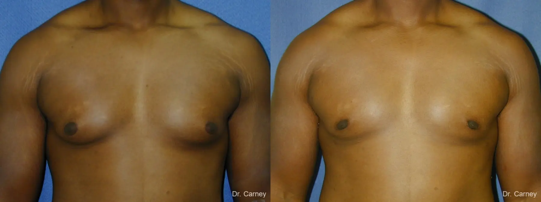 Virginia Beach Gynecomastia 1226 - Before and After