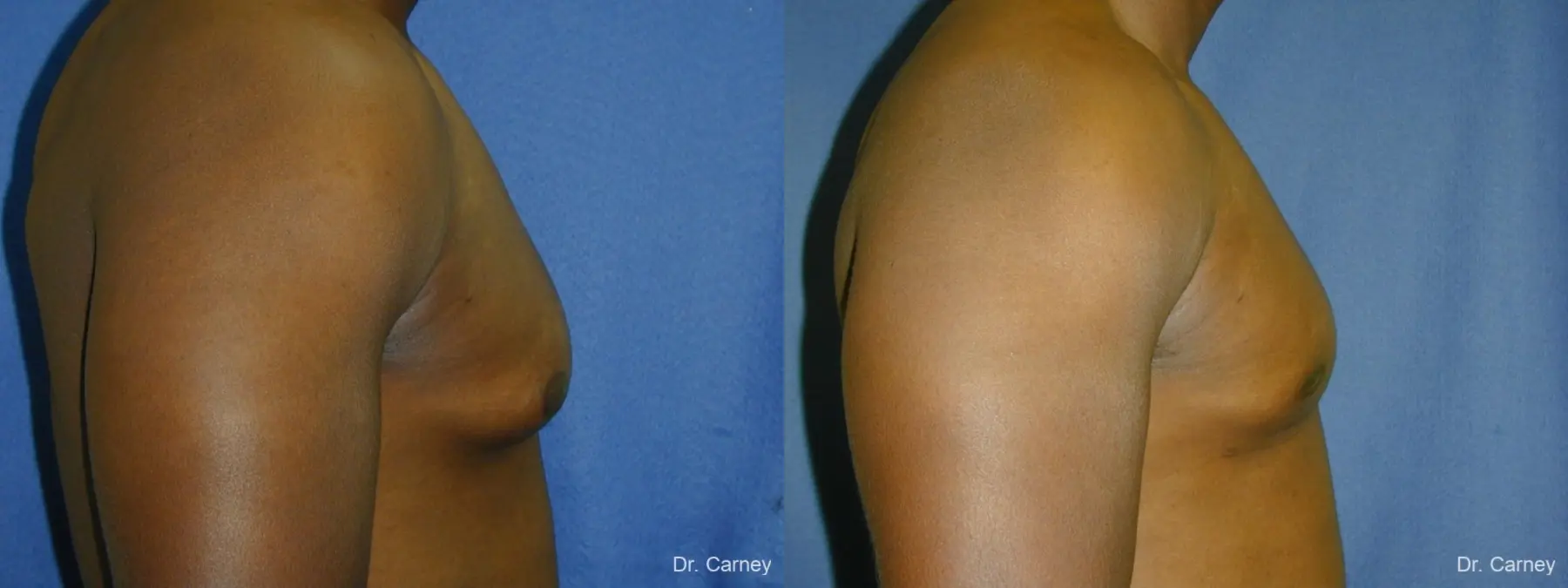Virginia Beach Gynecomastia 1226 - Before and After 4