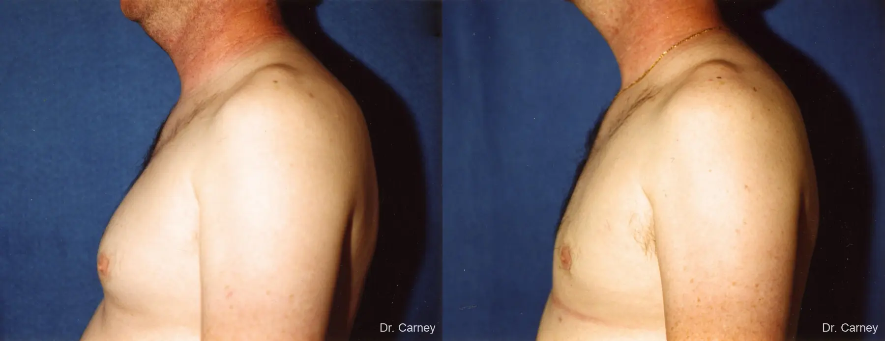 Virginia Beach Gynecomastia 1227 - Before and After 2