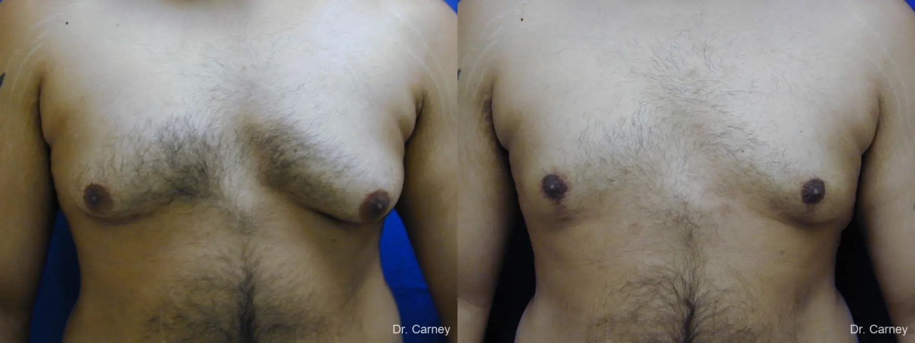 Virginia Beach Gynecomastia 1255 - Before and After 4