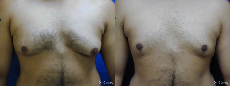 Virginia Beach Gynecomastia 1255 - Before and After 4