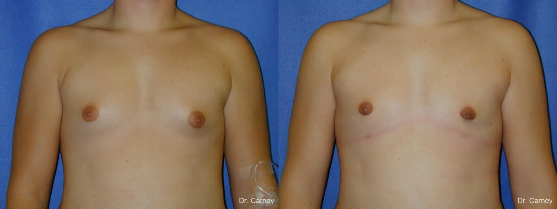 Virginia Beach Gynecomastia - Before and After 1