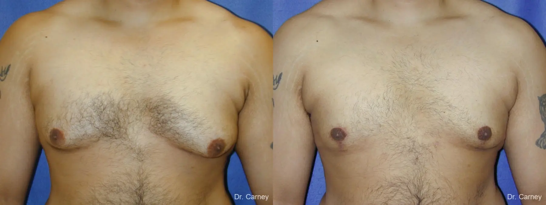 Virginia Beach Gynecomastia 1255 - Before and After