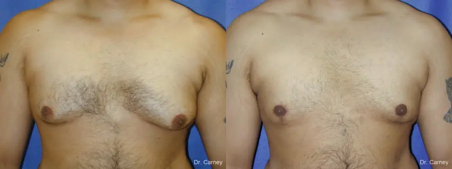 Virginia Beach Gynecomastia 1255 - Before and After 1