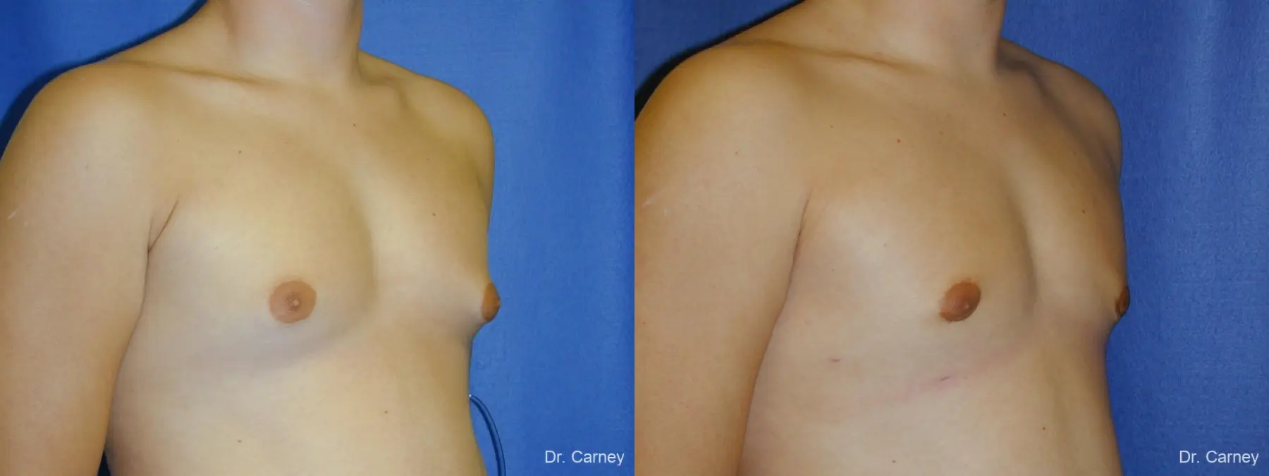 Virginia Beach Gynecomastia - Before and After 2