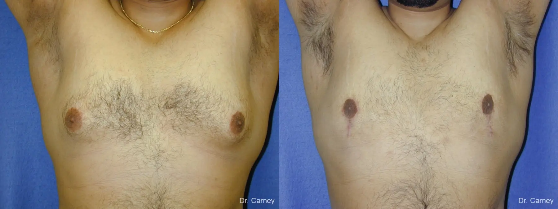 Virginia Beach Gynecomastia 1255 - Before and After 2