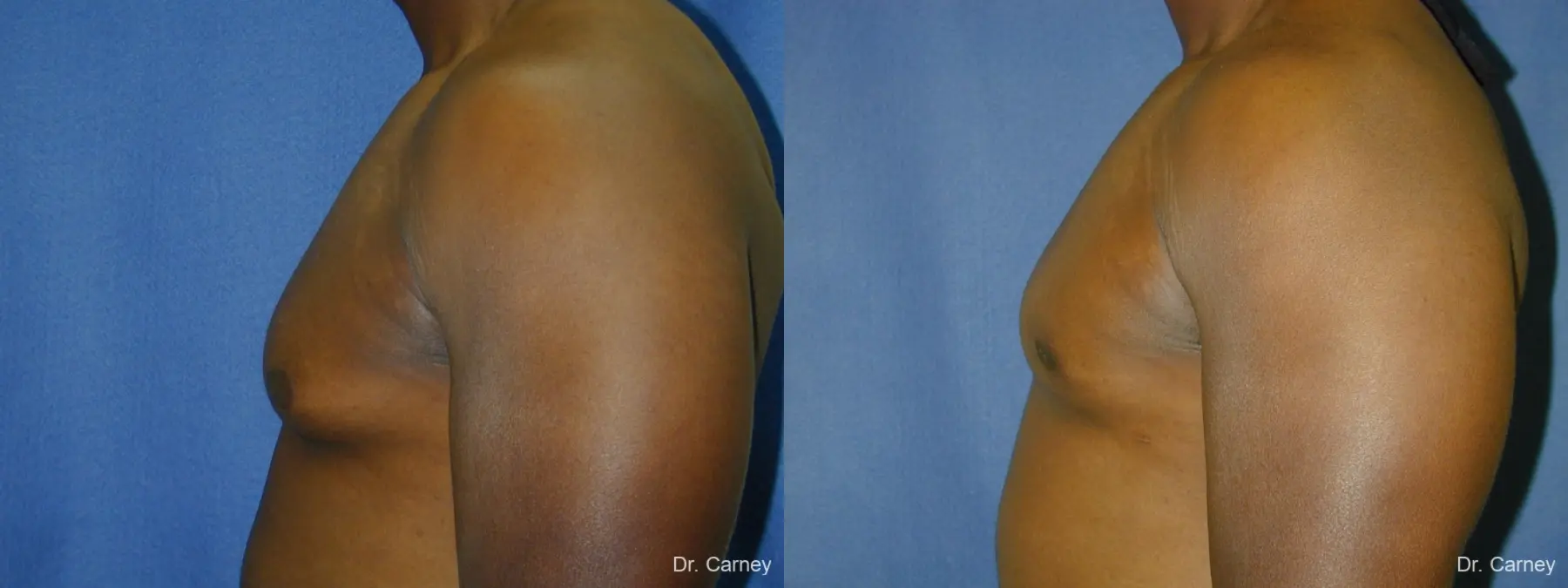 Virginia Beach Gynecomastia 1226 - Before and After 5