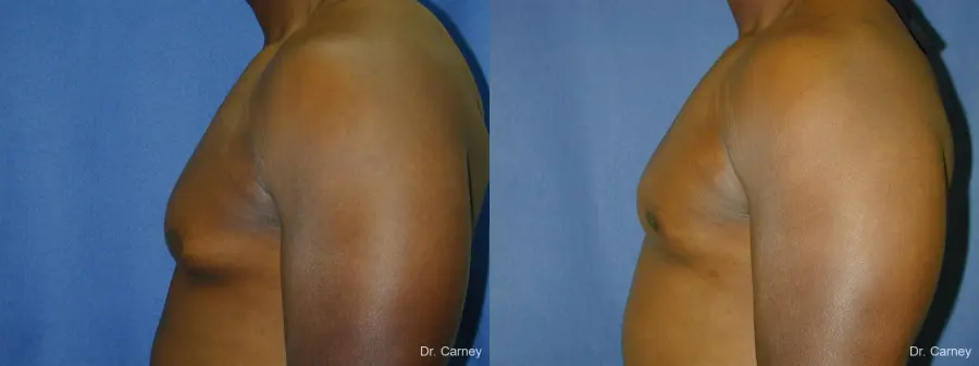Virginia Beach Gynecomastia 1226 - Before and After 5