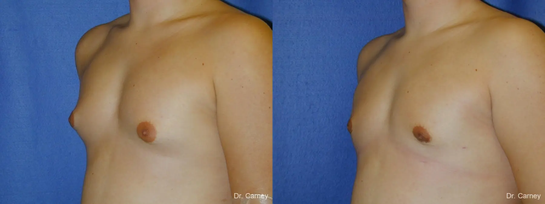 Virginia Beach Gynecomastia - Before and After 3