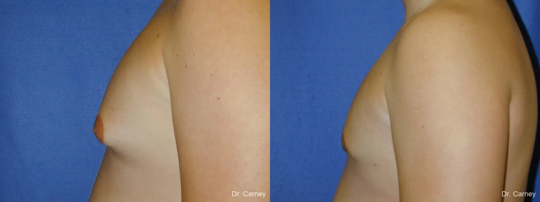 Virginia Beach Gynecomastia - Before and After 4