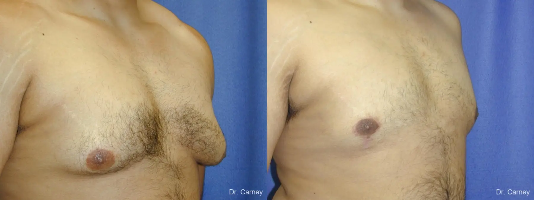Virginia Beach Gynecomastia 1255 - Before and After 3