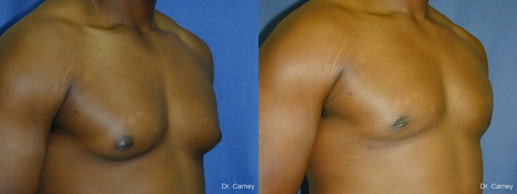 Virginia Beach Gynecomastia 1226 - Before and After 2