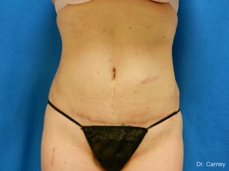 Virginia Beach Tummy Tuck 1251 - After Image 1