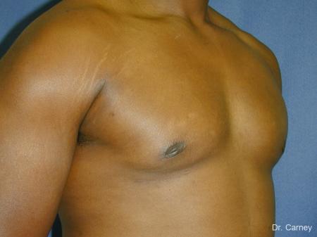 Virginia Beach Gynecomastia 1226 - After Image 2