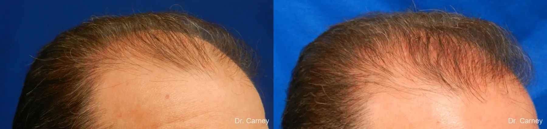 Hair Transplantation: Patient 16 - Before and After 3
