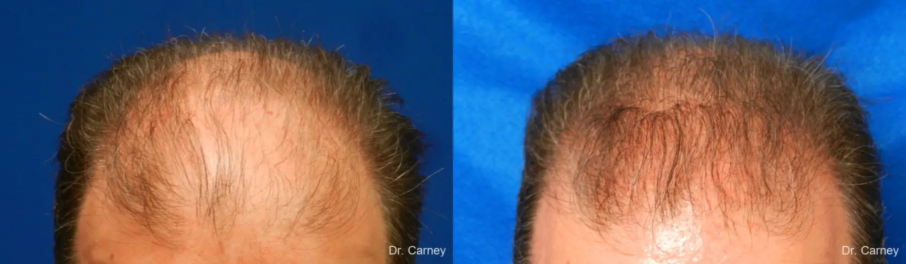 Hair Transplantation: Patient 16 - Before and After 2