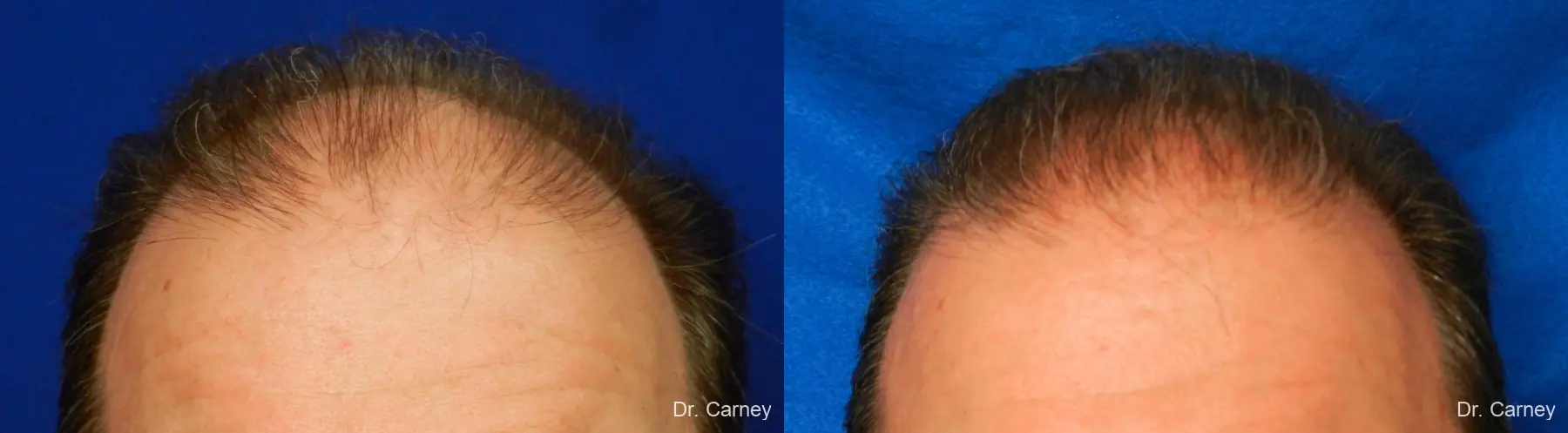 Hair Transplantation: Patient 16 - Before and After 1