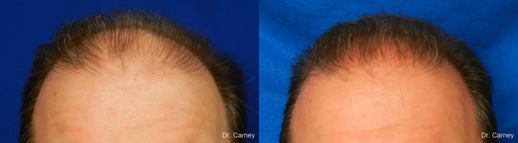 Hair Transplantation: Patient 16 - Before and After  