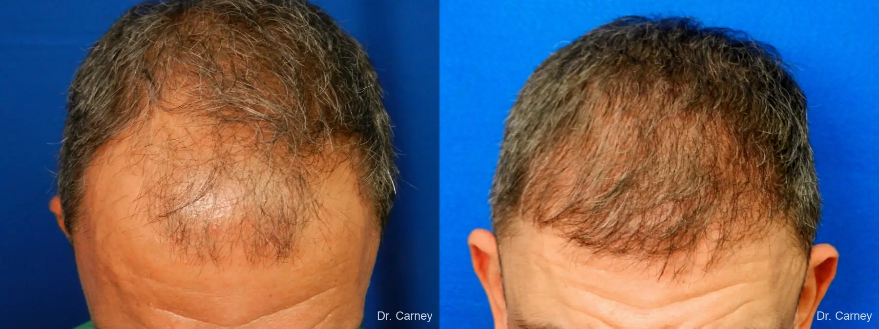 Hair Transplantation: Patient 17 - Before and After 1