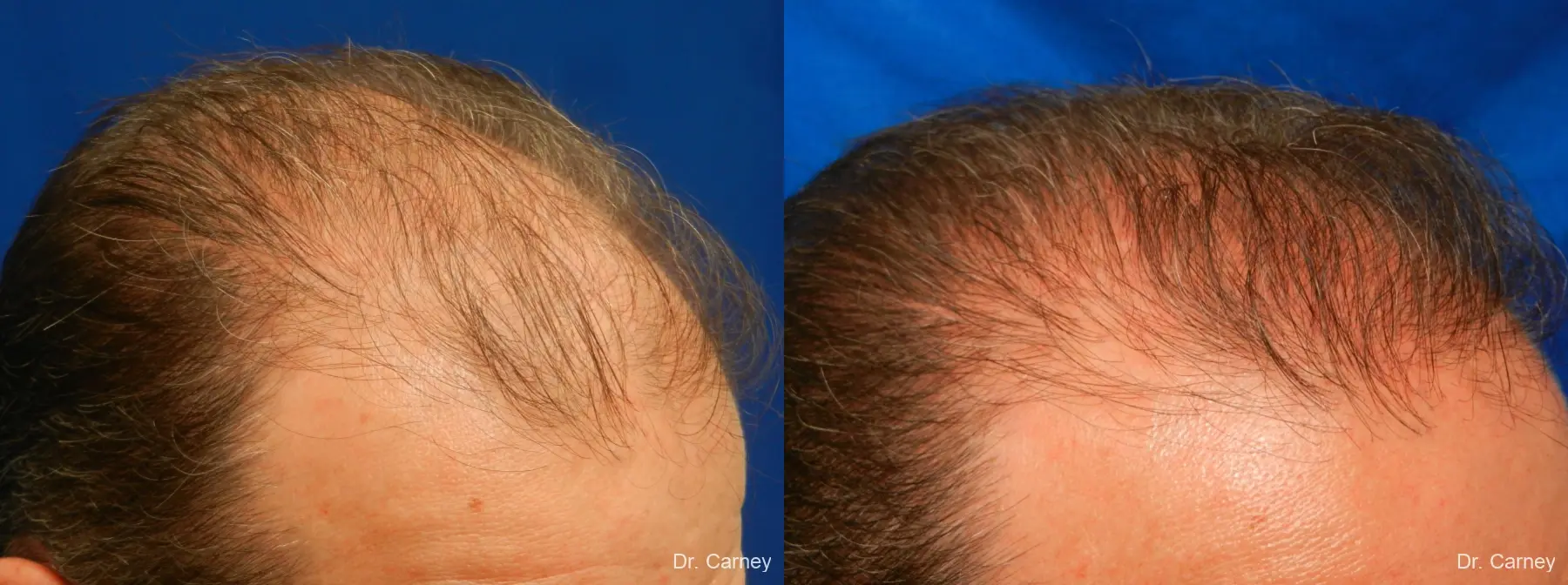 Hair Transplantation: Patient 16 - Before and After 4